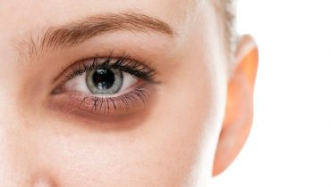 کوکتل درماهیل : درمان پف زیر چشم با ۱۲ توصیه ساده اما موثر